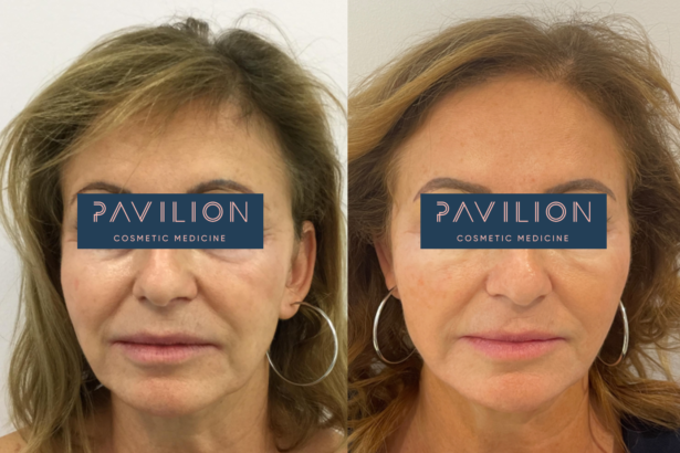 Brow and Eye Threadlift - Best Clinic Sydney for Dermal Fillers